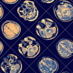 Logran tratar con éxito cánceres cerebrales infantiles incurables