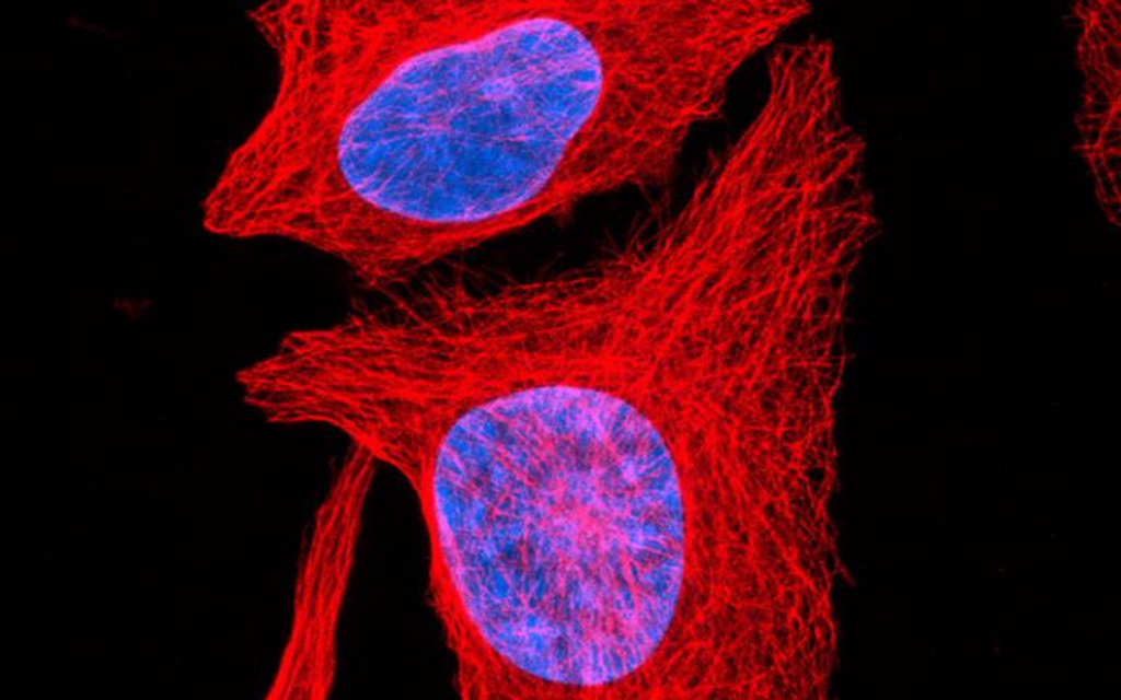 Investigadores españoles descubren qué provoca el cáncer óseo agresivo