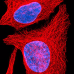 Investigadores españoles descubren qué provoca el cáncer óseo agresivo