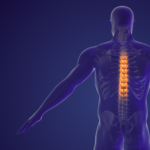 Estimulación espinal de alta frecuencia para reducir la espasticidad muscular