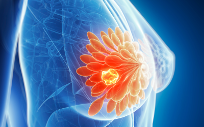 Nuevo fármaco innovador de dosis única para el cáncer de mama