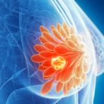 Nuevo fármaco innovador de dosis única para el cáncer de mama